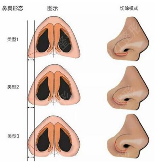 长春隆鼻整形哪家好