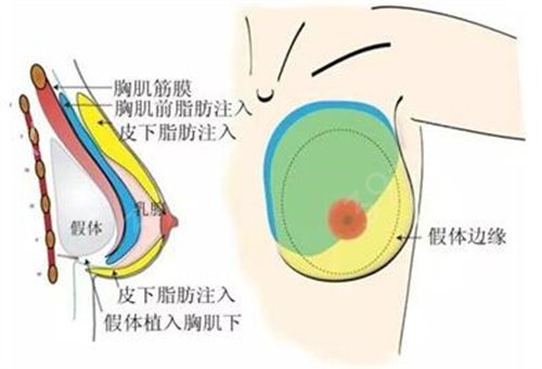鄭州豐胸醫(yī)院排行榜（公立篇）