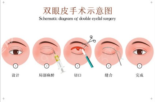 杭州哪家三甲医院割双眼皮好