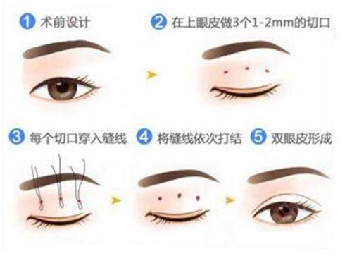 南昌做双眼皮哪家医院好