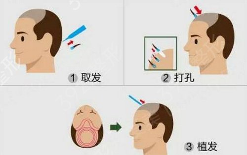 温州市人民医院植发吗
