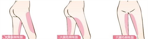 成都做吸脂手术哪家医院好