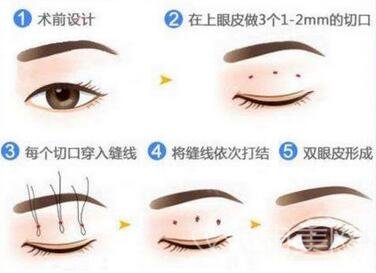 十堰安琪儿做双眼皮怎么样啊
