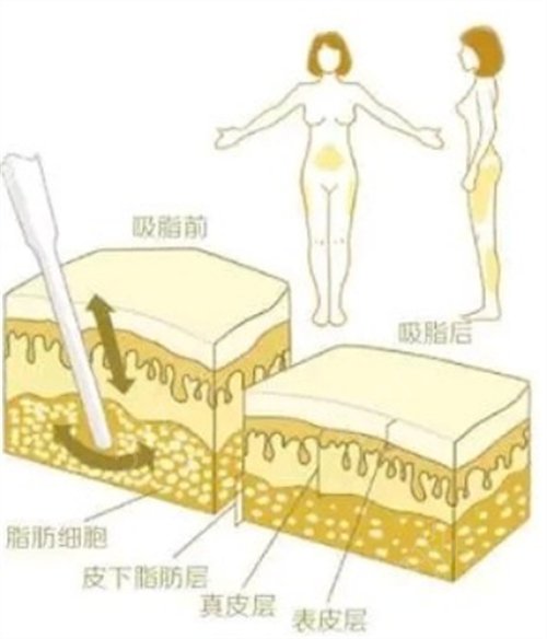 成都做吸脂手术哪家医院好