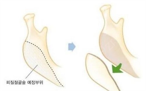 北京下颌角谁做得好