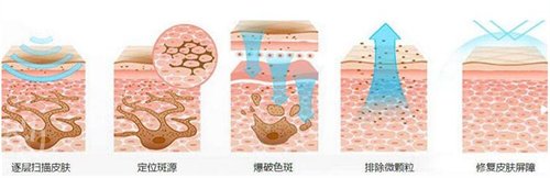 西寧時光激光祛斑果怎么樣