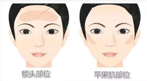 昆明华美美莱做的脂肪填充脸部