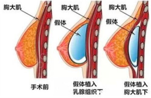 北京韩啸医疗美容医院专家排名_棉花糖隆胸案例_价格标准