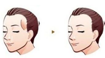 昆明艺星金辉_医院主页_太阳穴额头填充案例分享