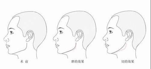 上海九院下颌角磨骨怎么样