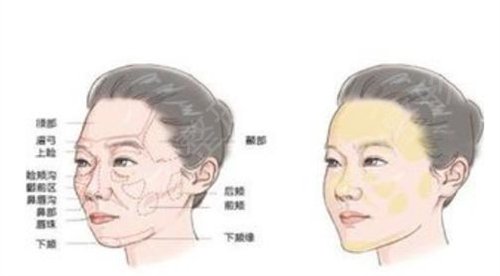 成都自體脂肪填充哪家醫(yī)院好