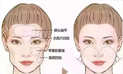 广州南方医院整形科脂肪填充怎么样