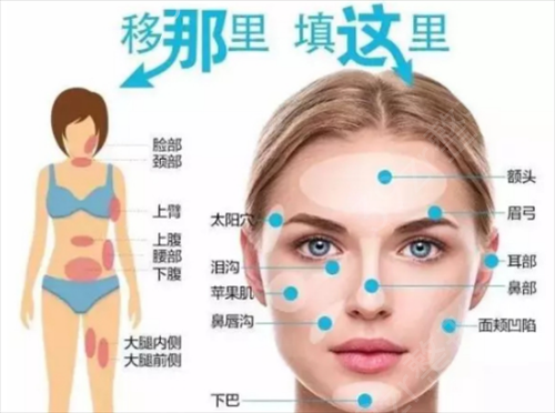 广州南方医院整形科脂肪填充怎么样