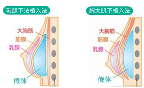 上海九院余力隆胸怎么样