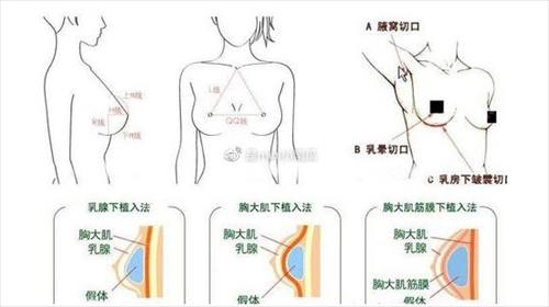 北京韩啸医疗美容医院专家排名_棉花糖隆胸案例_价格标准