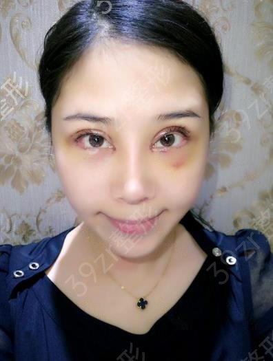 北京擅长双眼皮医院前十名公布