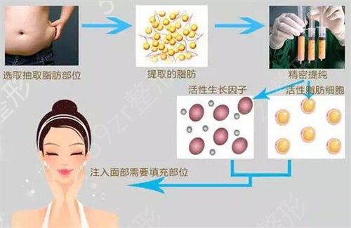 上海哪家自體脂肪填充技術(shù)好