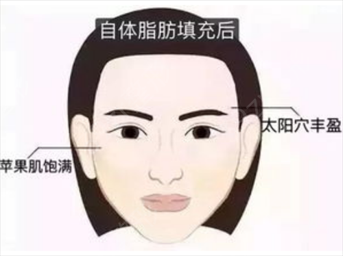 广州南方医院整形科脂肪填充怎么样