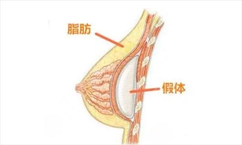 徐州正规隆胸假体取出医院_徐州二院美容整形科真人案例_价格表