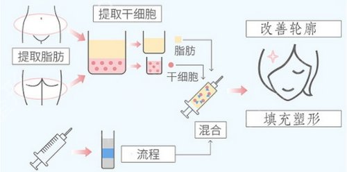 面部填充深圳哪个医生好