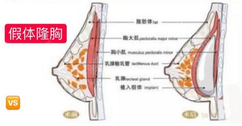 南京隆胸好的三甲医院排名