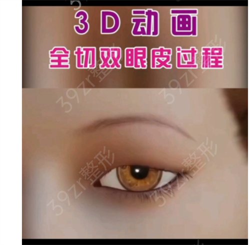 广州紫馨双眼皮修复*_术后真实案例反馈_价格明细查询