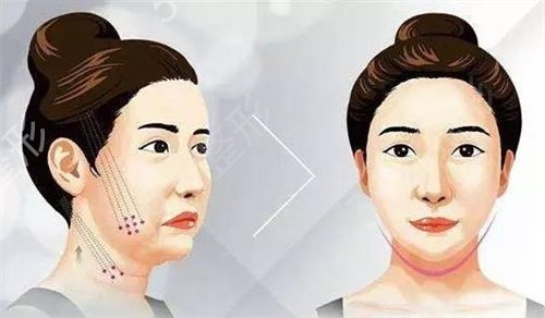 名流整形医院做拉皮除皱后