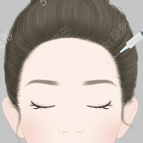 在长沙三和整形医院做了脂肪丰额头后