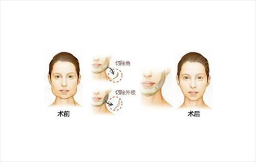 北京磨骨有名的专家排行榜名次查询