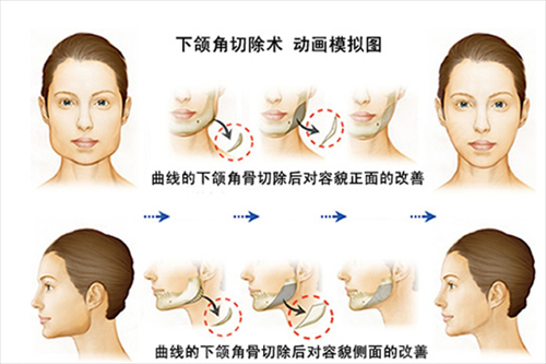 北京磨骨有名的专家排行榜名次查询