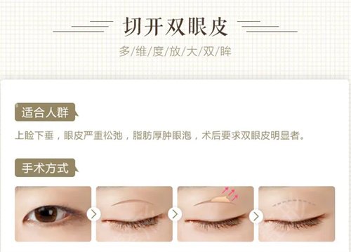 在溫州加美做了個美美的雙眼皮
