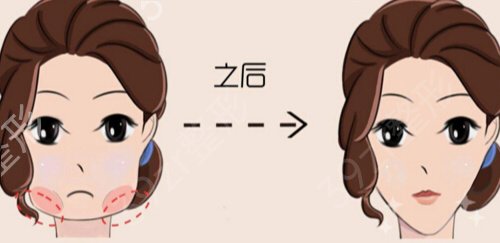 深圳下颌角医院哪家好
