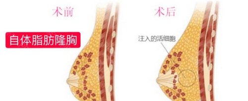 南京隆胸好的三甲医院排名
