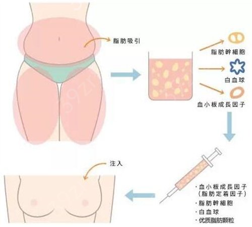 北京英煌梁耀婵自体脂肪隆胸好吗