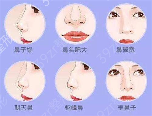 杭州做隆鼻哪家医院好