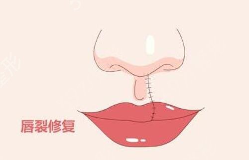 北大口腔医院做唇裂修复*