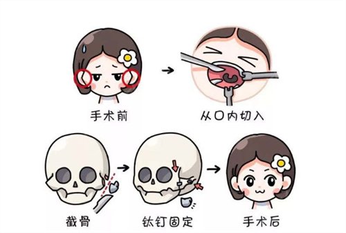 上海磨骨厉害的医生谁技术更牛