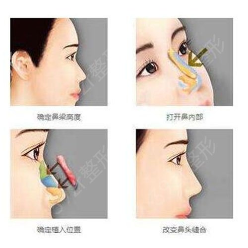 常州美贝尔做的双眼皮和隆鼻