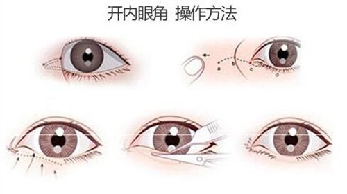 泰安中心医院整形科割双眼皮怎么样