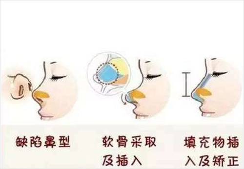 东莞隆鼻医院排名榜前五医美大全发布