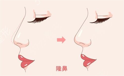 常州隆鼻哪家好一点