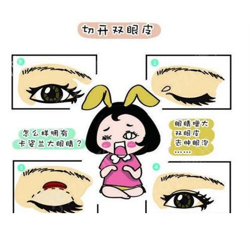 伊美尔做韩式三点双眼皮多少钱