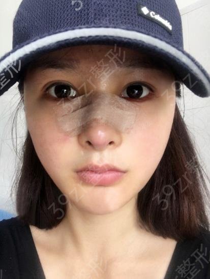 杭州假体隆鼻医院哪家好