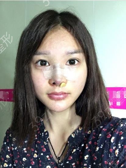 杭州假体隆鼻医院哪家好