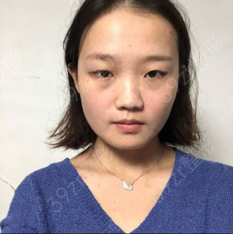 沈阳杏林张莹莹和房红超双眼皮哪个好