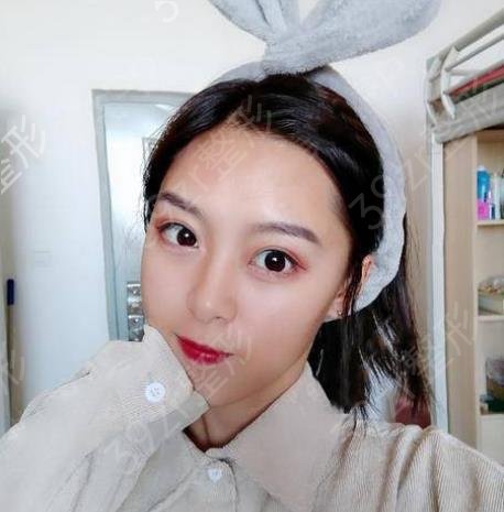 沈阳杏林张莹莹和房红超双眼皮哪个好