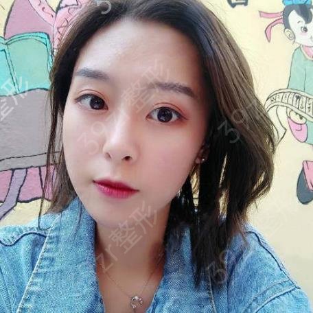 沈阳杏林张莹莹和房红超双眼皮哪个好