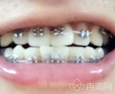 邯郸三院牙齿矫正怎么样