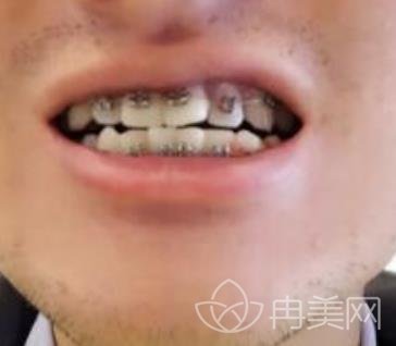 邯郸三院牙齿矫正怎么样