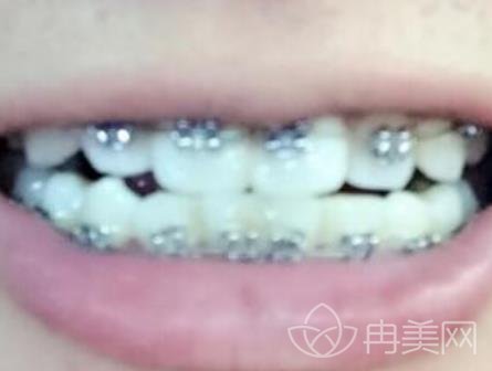 邯郸三院牙齿矫正怎么样